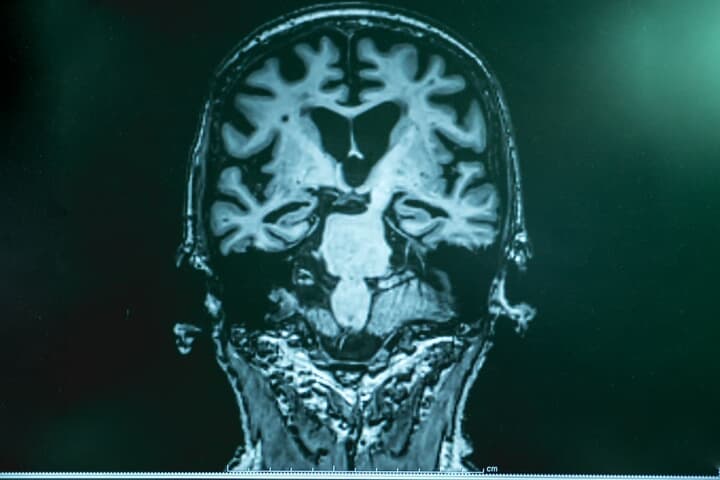 アルツハイマー症の患者のMRI画像