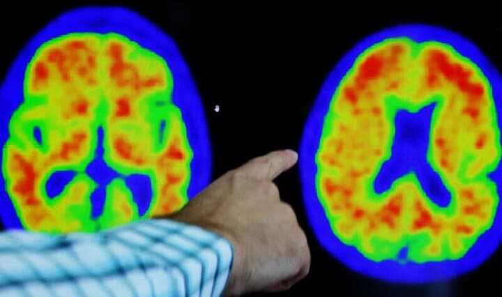 アルツハイマー病の症状を示す脳のCT画像
